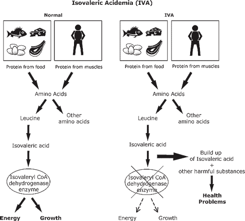 Rối loạn chuyển hóa: Bệnh Isovaleric Acidema (IVA) do thiếu hụt enzyme Isovaleric Acid CoA Dehydrogenase