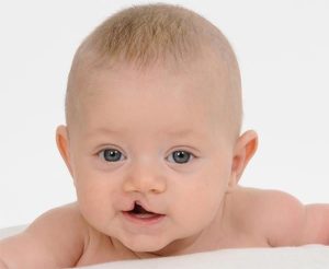 Hình ảnh trẻ mắc Hội chứng Patau
