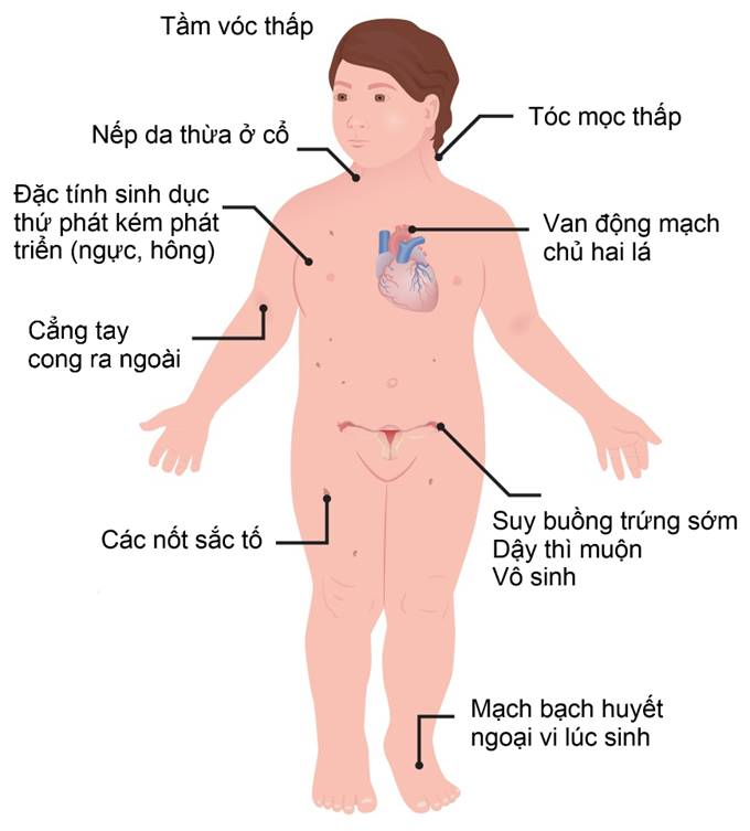 Hội chứng Turner 