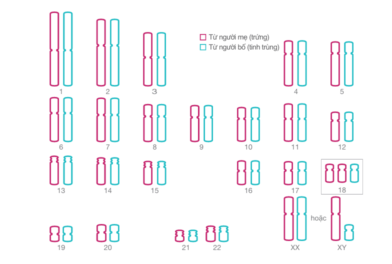 Hội chứng tam NST 18 (Hội chứng Edwards)