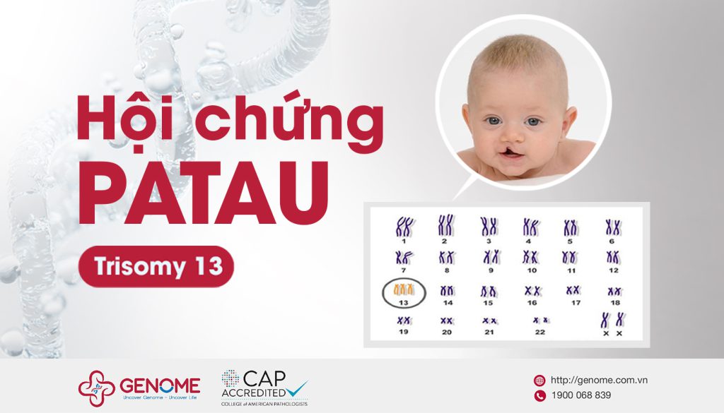 Hội chứng Patau (Trisomy 13)