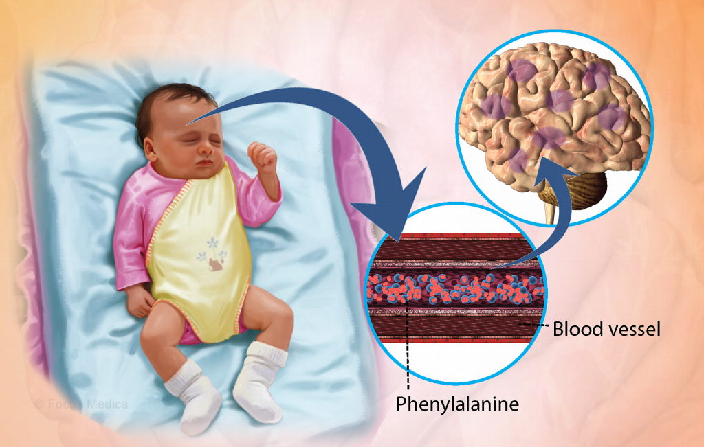 Bệnh Phenylketon niệu (Nhóm bệnh Rối loạn chuyển hóa)