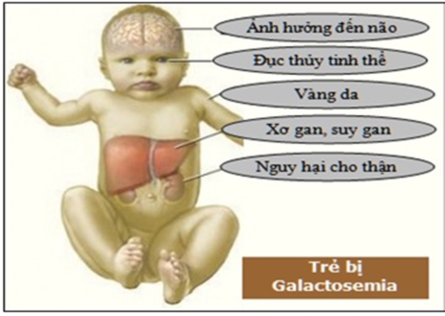 Dấu hiệu bệnh rối loạn chuyển hóa galactose