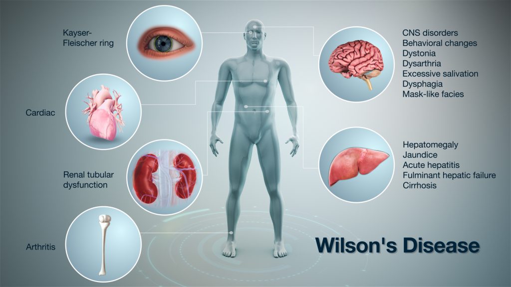Bệnh Wilson – Rối loạn chuyển hóa đồng (Phần 2)