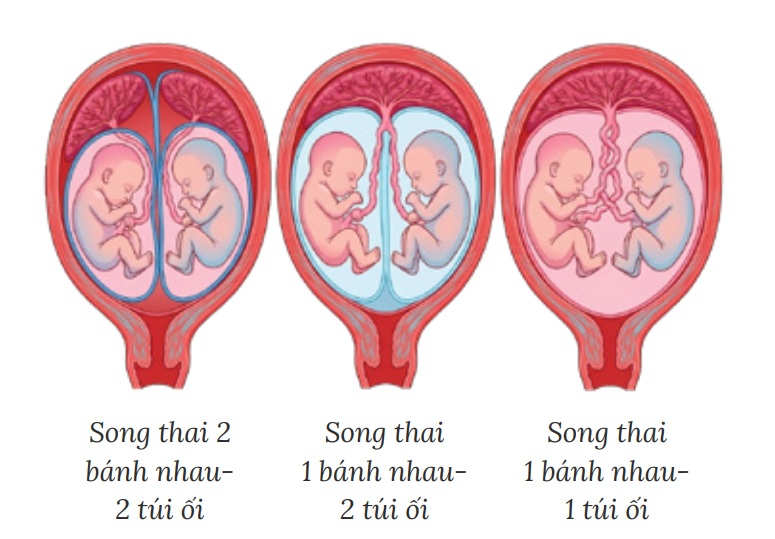 Sàng lọc trước sinh không xâm lấm (NIPT) ở song thai cần lưu ý
